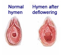 Before-after-hymen-deflowering